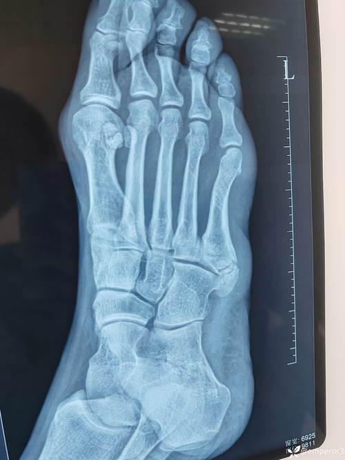 儿童第五跖骨突出是正常生理现象还是病理性异常？附图片解析与应对建议-第3张图片-郑州医学网