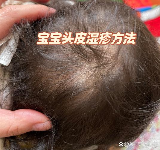新生儿头皮湿疹反反复复，到底该怎么护理才能好得快？-第2张图片-郑州医学网