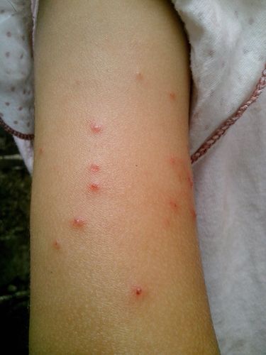 儿童皮肤红点且瘙痒不止，究竟是什么原因引起的？-第3张图片-郑州医学网