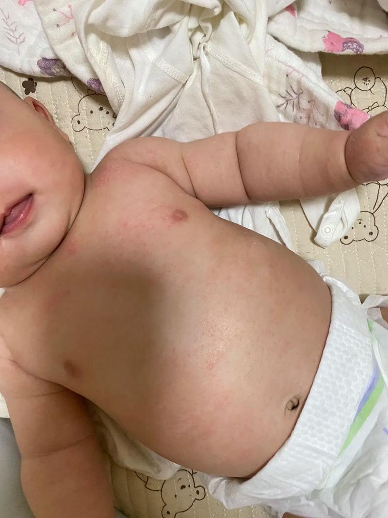 儿童皮肤红点且瘙痒不止，究竟是什么原因引起的？-第2张图片-郑州医学网