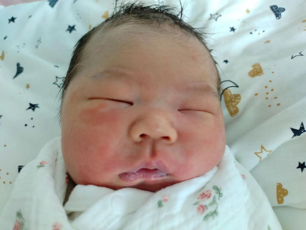 新生儿额头V字红斑图片是正常现象还是疾病信号？-第3张图片-郑州医学网