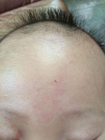 新生儿额头V字红斑图片是正常现象还是疾病信号？-第1张图片-郑州医学网