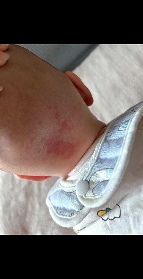 新生儿额头V字红斑图片是正常现象还是疾病信号？-第2张图片-郑州医学网