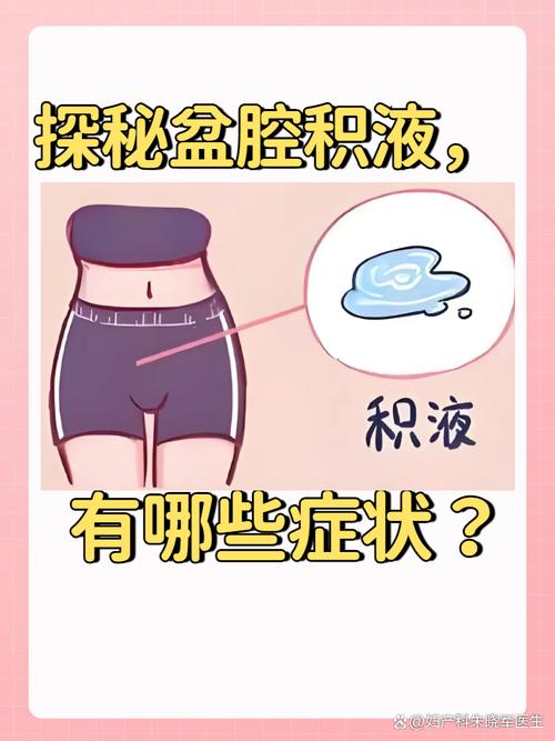备孕期查出盆腔积液会影响怀孕吗？需要治疗吗？-第3张图片-郑州医学网