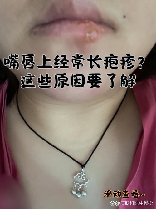 孕期嘴唇长泡能擦药吗?哪些安全药膏能缓解不适?-第3张图片-郑州医学网 孕期嘴唇长泡能擦药吗?哪些安全药膏能缓解不适?-第3张图片-郑州医学网
