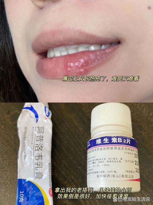孕期嘴唇长泡能擦药吗?哪些安全药膏能缓解不适?-第1张图片-郑州医学网 孕期嘴唇长泡能擦药吗?哪些安全药膏能缓解不适?-第1张图片-郑州医学网