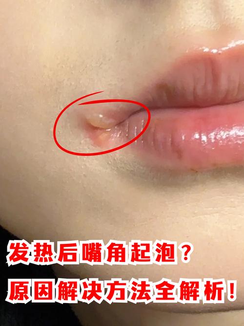 孕期嘴唇长泡能擦药吗？哪些安全药膏能缓解不适？-第2张图片-郑州医学网