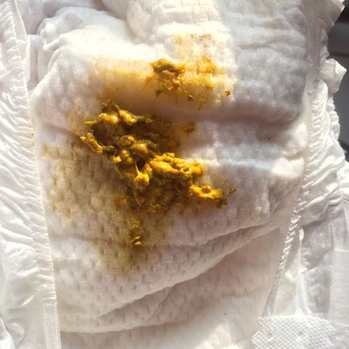 20天新生儿拉屎有泡沫是消化不良还是感染了？-第2张图片-郑州医学网