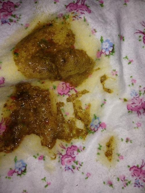 20天新生儿拉屎有泡沫是消化不良还是感染了？-第3张图片-郑州医学网