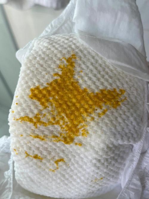 20天新生儿拉屎有泡沫是消化不良还是感染了?-第1张图片-郑州医学网 20天新生儿拉屎有泡沫是消化不良还是感染了?-第1张图片-郑州医学网