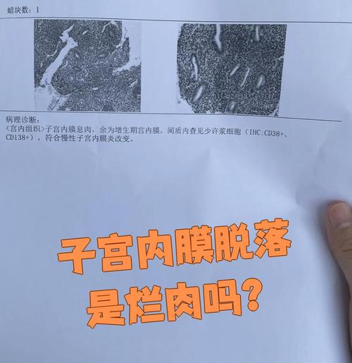 孕期子宫内膜会脱落吗？孕期子宫内膜脱落是否正常？-第1张图片-郑州医学网