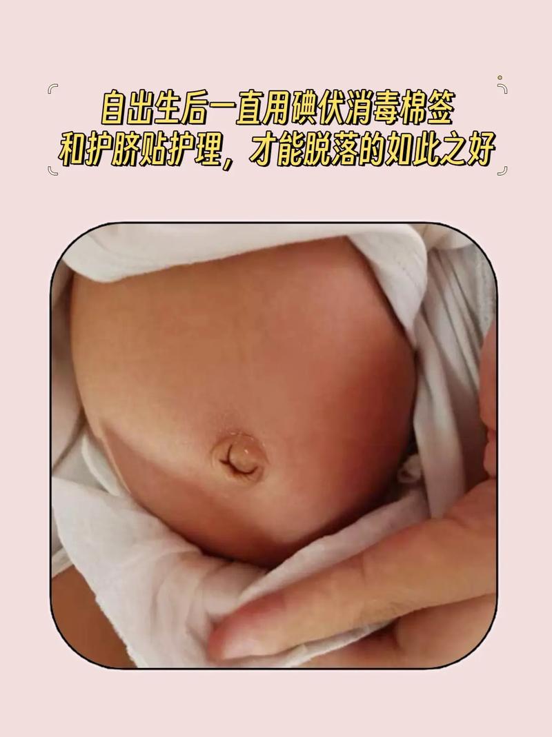 新生儿肚脐50天未脱落，是正常现象还是异常信号？需如何处理？-第2张图片-郑州医学网