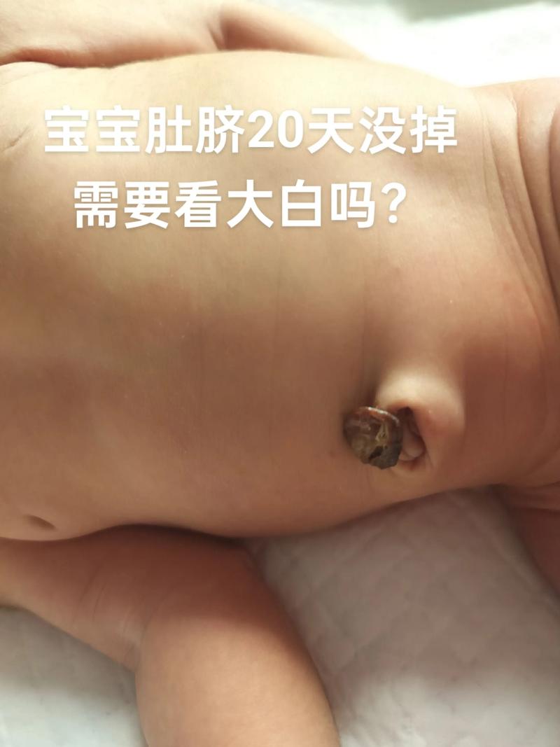 新生儿肚脐50天未脱落,是正常现象还是异常信号?需如何处理?-第1张图片-郑州医学网 新生儿肚脐50天未脱落,是正常现象还是异常信号?需如何处理?-第1张图片-郑州医学网