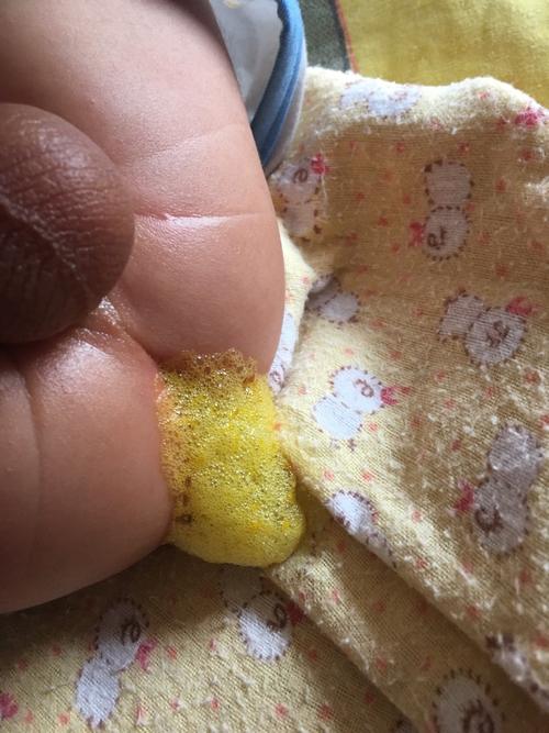 10天新生儿大便带泡沫是消化不良还是感染？需就医吗？-第2张图片-郑州医学网