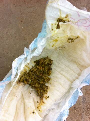 10天新生儿大便带泡沫是消化不良还是感染?需就医吗?-第3张图片-郑州医学网 10天新生儿大便带泡沫是消化不良还是感染?需就医吗?-第3张图片-郑州医学网