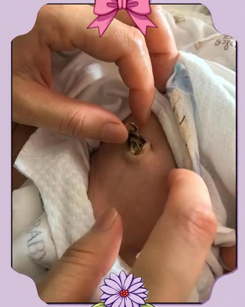 6天新生儿肚脐消毒视频,正确操作步骤和注意事项有哪些?-第1张图片-郑州医学网 6天新生儿肚脐消毒视频,正确操作步骤和注意事项有哪些?-第1张图片-郑州医学网