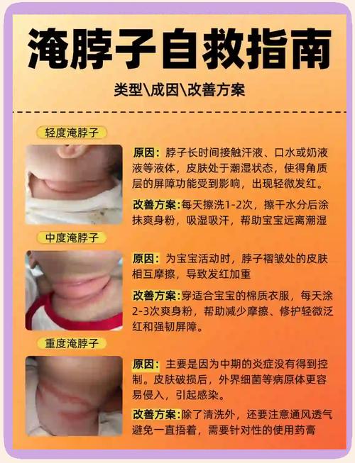 新生儿脖子湿疹反反复复，到底该怎么护理才能好得快？-第2张图片-郑州医学网