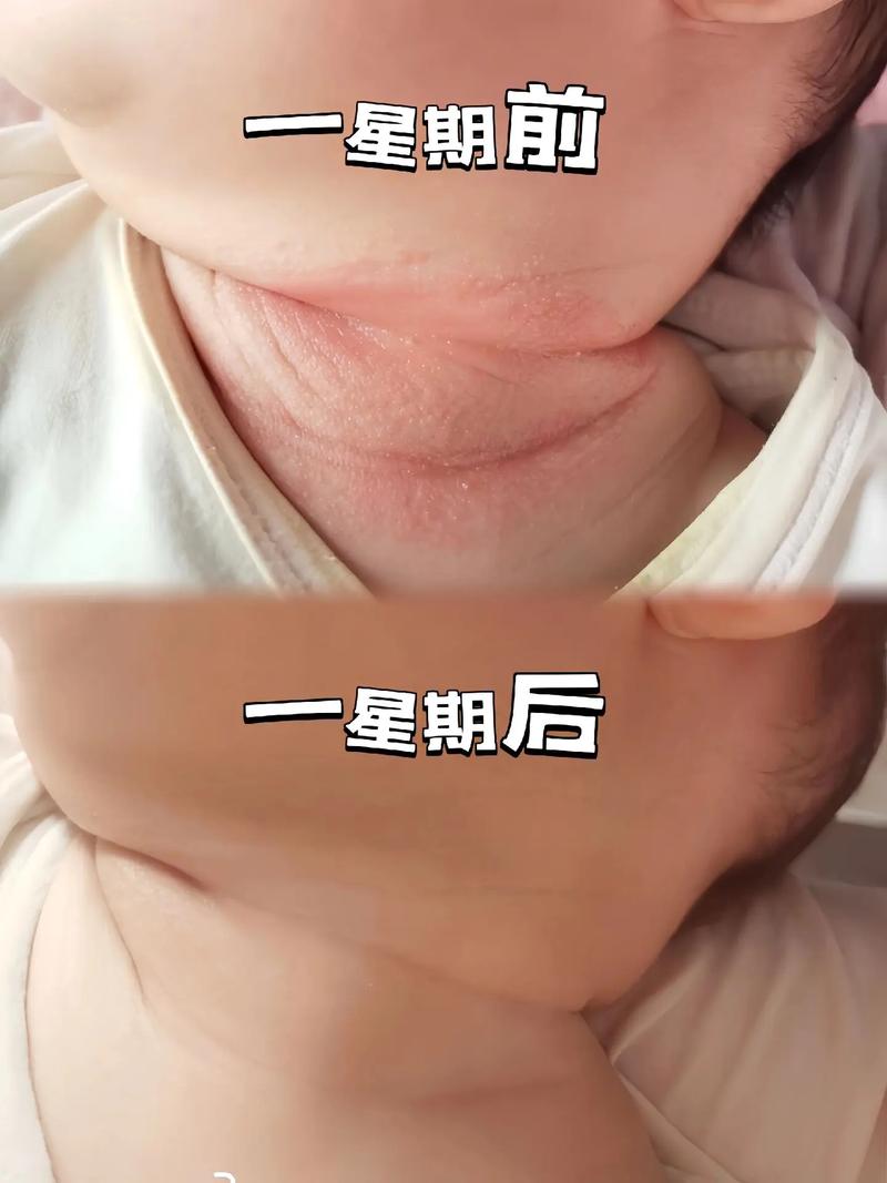 新生儿脖子湿疹反反复复，到底该怎么护理才能好得快？-第3张图片-郑州医学网