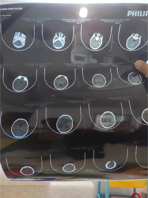 新生儿CT脑白质密度低是正常发育现象还是病理性异常？-第1张图片-郑州医学网