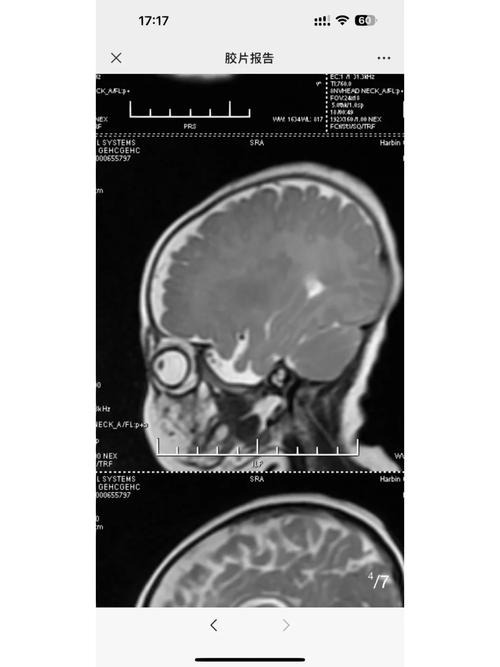 新生儿CT脑白质密度低是正常发育现象还是病理性异常？-第2张图片-郑州医学网