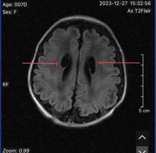 新生儿CT脑白质密度低是正常发育现象还是病理性异常？-第3张图片-郑州医学网