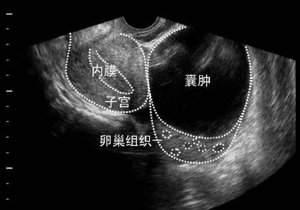 孕期卵巢囊肿会破裂吗?破裂风险高吗?对胎儿有影响吗?-第3张图片-郑州医学网 孕期卵巢囊肿会破裂吗?破裂风险高吗?对胎儿有影响吗?-第3张图片-郑州医学网