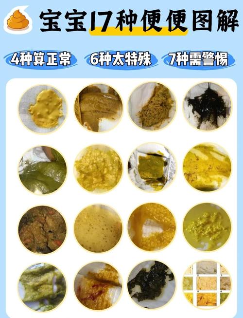 新生儿母乳一天大便10多次，是正常现象还是消化异常？-第2张图片-郑州医学网