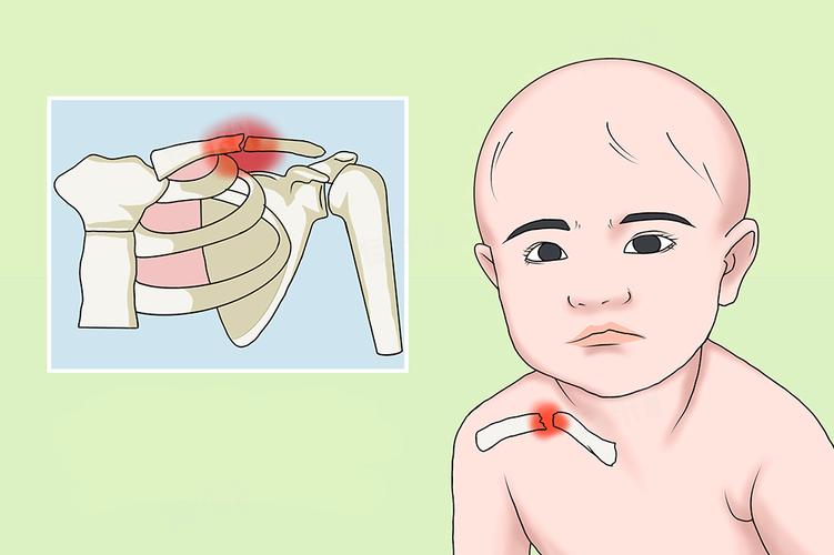 新生儿锁骨骨折后，家长该如何科学护理才能促进愈合并避免二次伤害？-第2张图片-郑州医学网