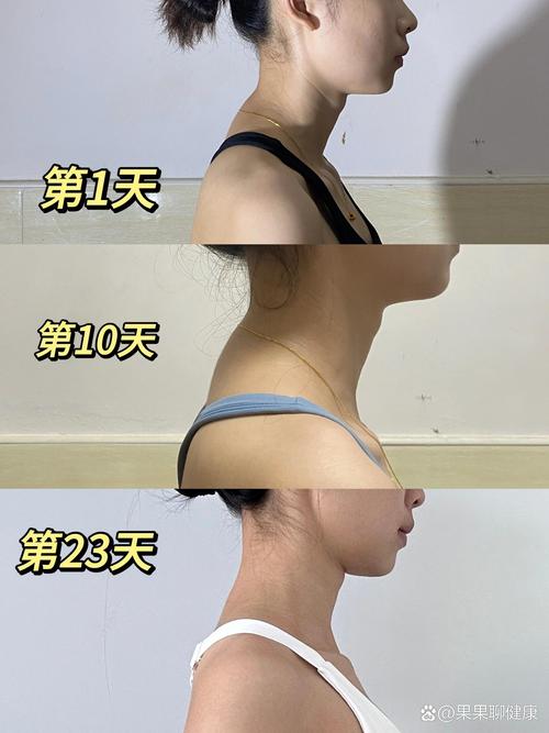 儿童富贵包是怎么形成的？需要从不良姿势、骨骼发育还是脂肪堆积找原因？-第3张图片-郑州医学网