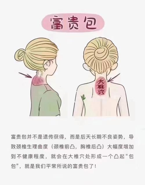 儿童富贵包是怎么形成的？需要从不良姿势、骨骼发育还是脂肪堆积找原因？-第1张图片-郑州医学网