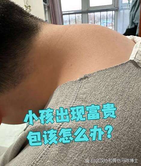儿童富贵包是怎么形成的？需要从不良姿势、骨骼发育还是脂肪堆积找原因？-第2张图片-郑州医学网