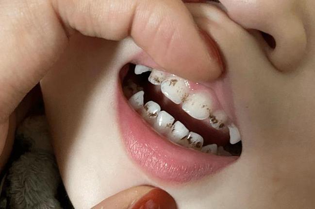 儿童氟斑牙前期图片有哪些典型表现？如何通过早期图片识别与预防？-第2张图片-郑州医学网