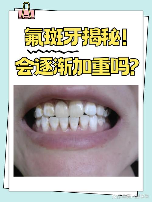 儿童氟斑牙前期图片有哪些典型表现？如何通过早期图片识别与预防？-第1张图片-郑州医学网