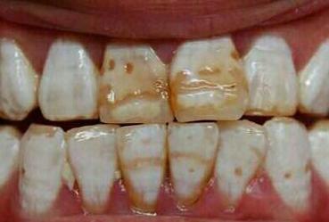 儿童氟斑牙前期图片有哪些典型表现？如何通过早期图片识别与预防？-第3张图片-郑州医学网