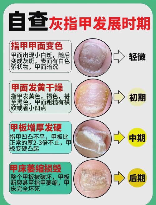 孕期患灰指甲能用亮甲吗？对胎儿有影响吗？-第2张图片-郑州医学网