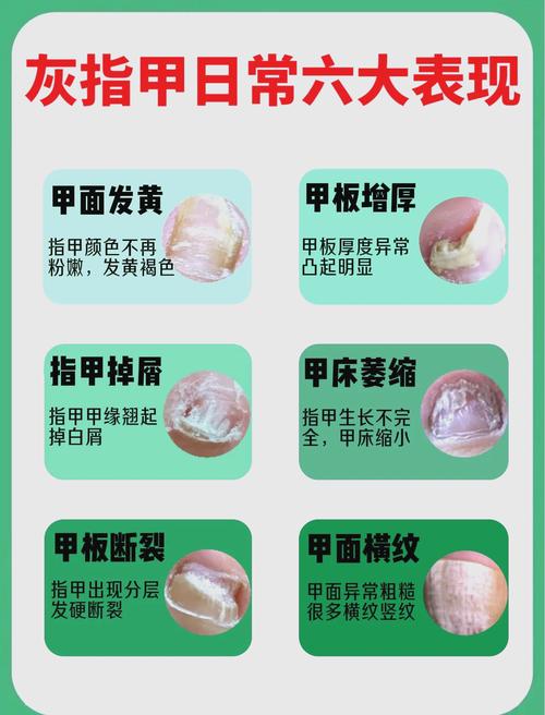 孕期患灰指甲能用亮甲吗？对胎儿有影响吗？-第3张图片-郑州医学网