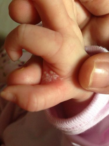 儿童手指上长透明水泡是手足口病还是湿疹？需要警惕哪些问题？-第3张图片-郑州医学网