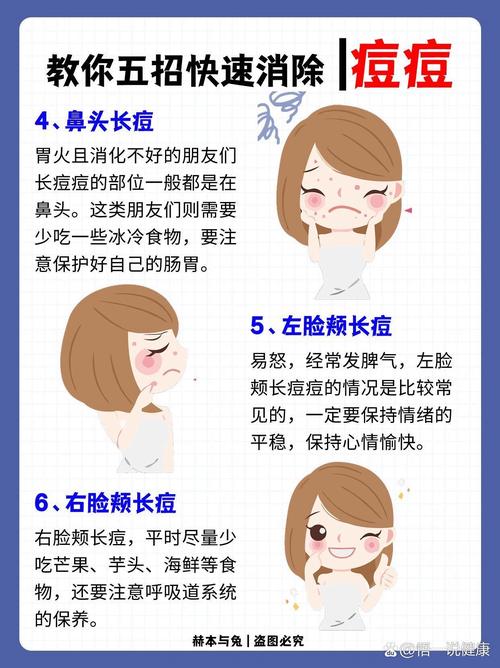 孕期脸上长粉刺怎么办?安全有效的祛痘方法有哪些?-第3张图片-郑州医学网 孕期脸上长粉刺怎么办?安全有效的祛痘方法有哪些?-第3张图片-郑州医学网