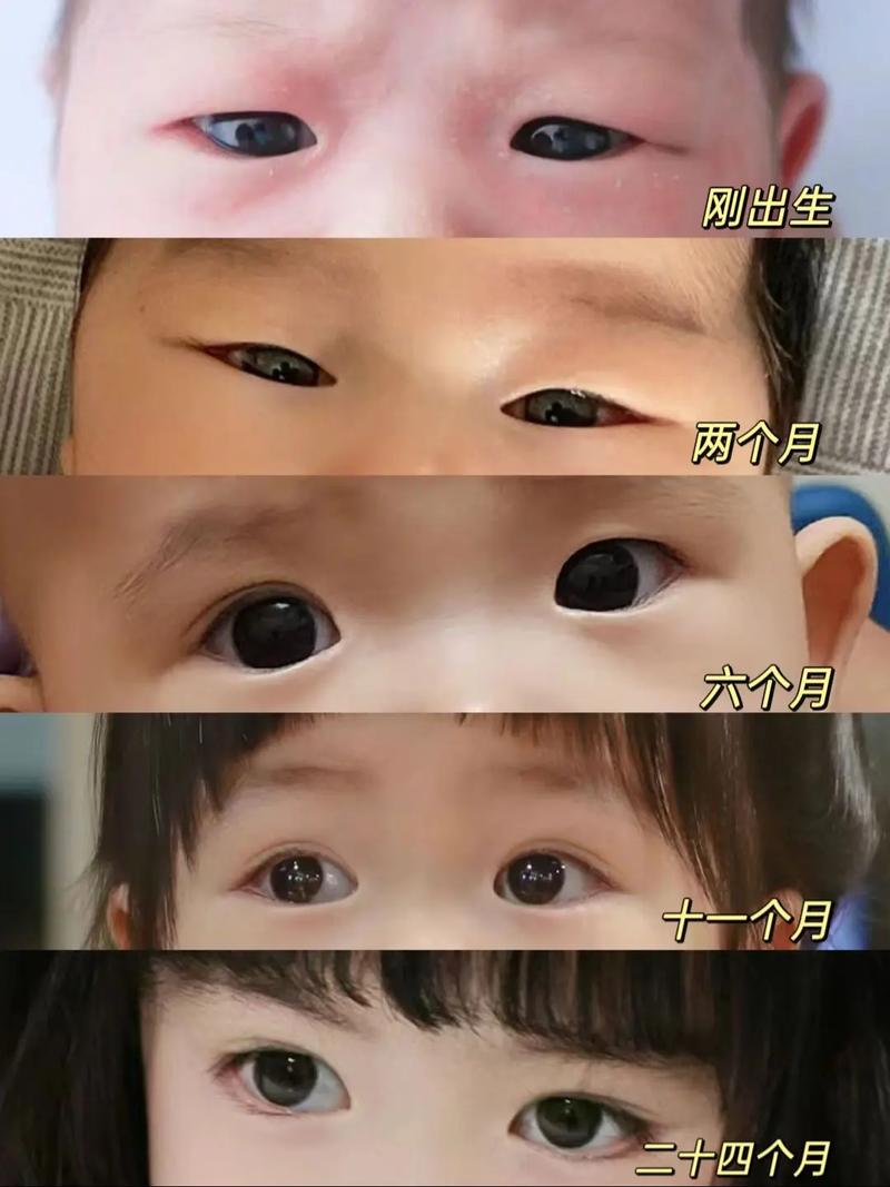 新生儿单双眼皮会随年龄变化吗?如何科学判断未来眼皮类型?-第3张图片-郑州医学网 新生儿单双眼皮会随年龄变化吗?如何科学判断未来眼皮类型?-第3张图片-郑州医学网