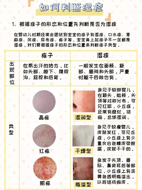 新生儿湿疹严重反复发作，到底该如何科学护理与治疗？-第2张图片-郑州医学网