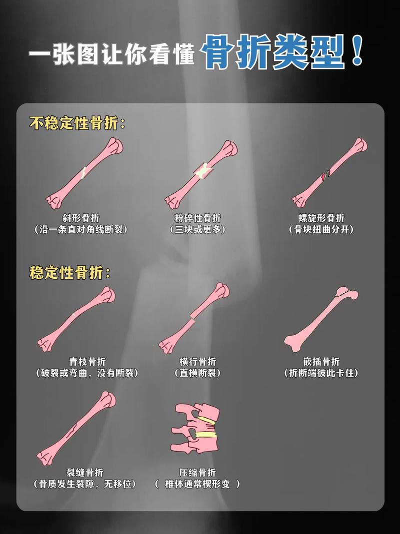 儿童最常见的骨折类型是什么？不同年龄段儿童骨折类型有何差异？-第1张图片-郑州医学网