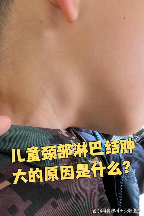 儿童颌下腺淋巴结肿大是什么原因引起的？需要治疗吗？-第2张图片-郑州医学网