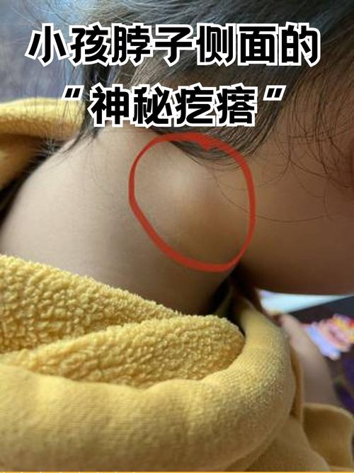 儿童颌下腺淋巴结肿大是什么原因引起的？需要治疗吗？-第3张图片-郑州医学网