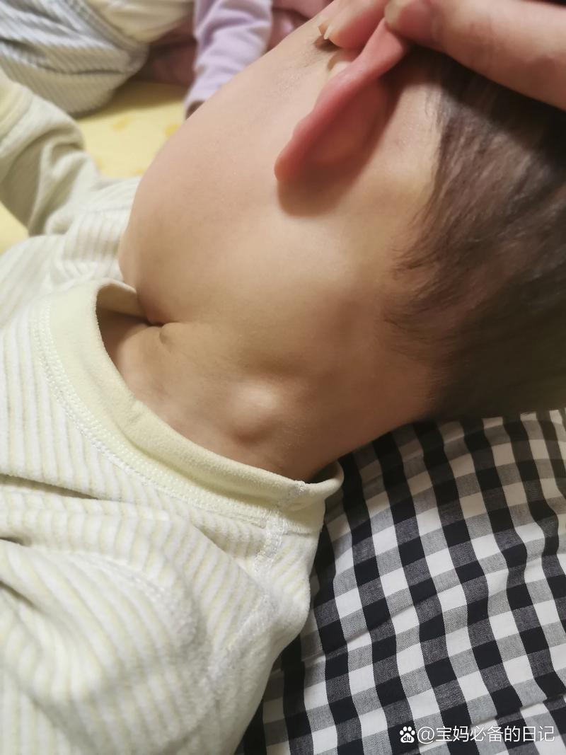 儿童颌下腺淋巴结肿大是什么原因引起的？需要治疗吗？-第1张图片-郑州医学网