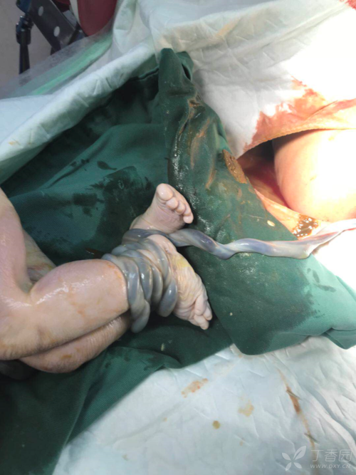 怀孕期间死胎会有哪些症状表现？孕妇该如何及时察觉异常？-第1张图片-郑州医学网