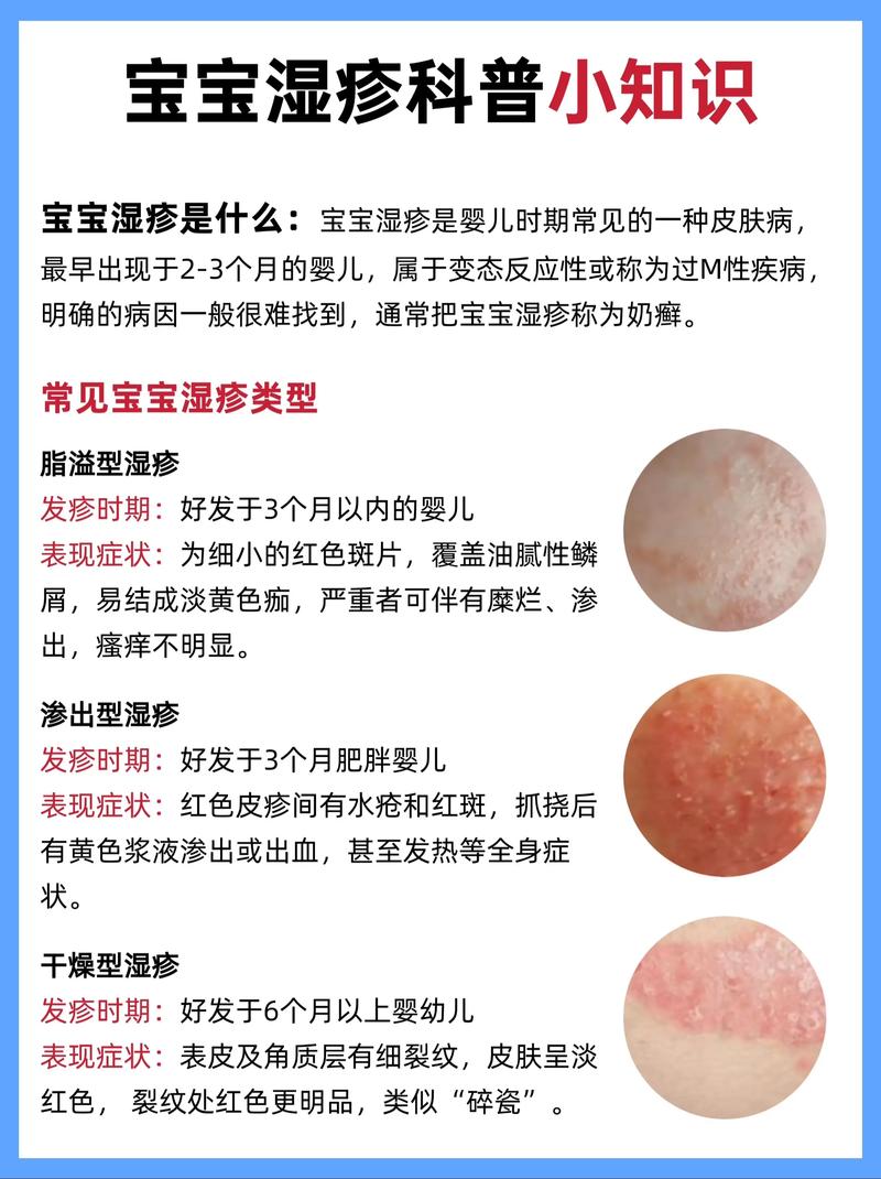 新生儿湿疹反反复复难断根,到底怎么治才能好得快还不复发?-第1张图片-郑州医学网 新生儿湿疹反反复复难断根,到底怎么治才能好得快还不复发?-第1张图片-郑州医学网