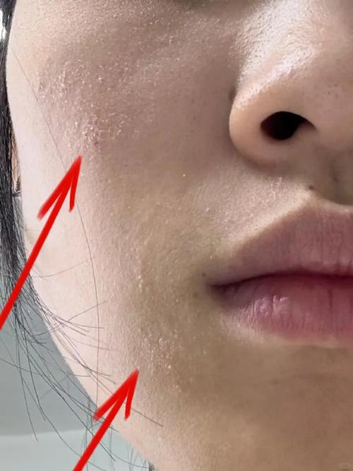 怀孕期间面部干燥脱皮是缺水还是激素变化导致的?-第3张图片-郑州医学网 怀孕期间面部干燥脱皮是缺水还是激素变化导致的?-第3张图片-郑州医学网