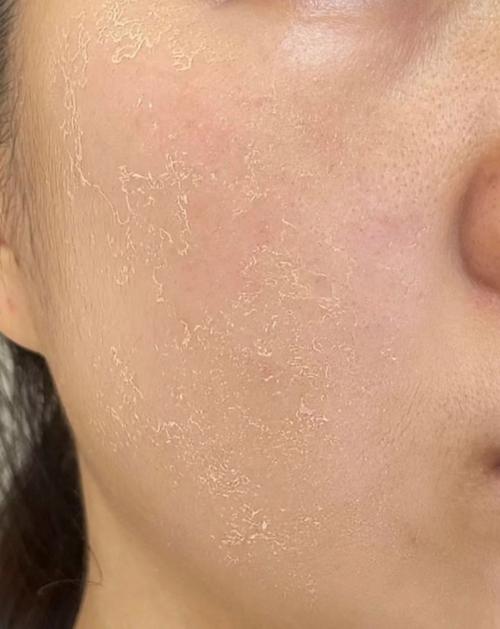 怀孕期间面部干燥脱皮是缺水还是激素变化导致的?-第1张图片-郑州医学网 怀孕期间面部干燥脱皮是缺水还是激素变化导致的?-第1张图片-郑州医学网