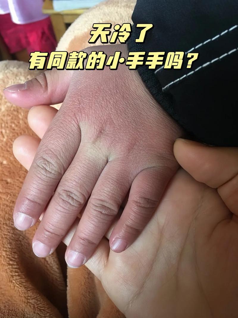 新生儿手脚冰凉是正常现象还是健康预警?体温调节机制有何特别之处?-第1张图片-郑州医学网 新生儿手脚冰凉是正常现象还是健康预警?体温调节机制有何特别之处?-第1张图片-郑州医学网