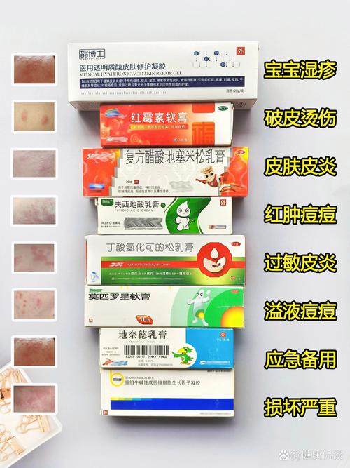 新生儿湿疹用药安全第一，到底该如何选择才有效？-第1张图片-郑州医学网